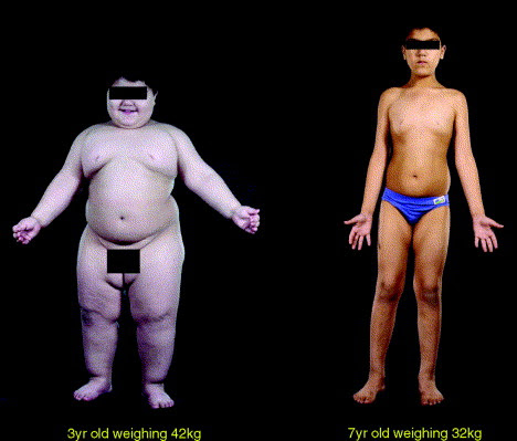 leptin-kid